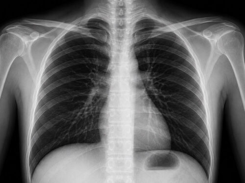 X-ray Report - One Anatomical Region