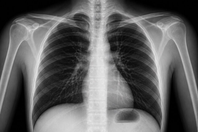X-ray Report - One Anatomical Region